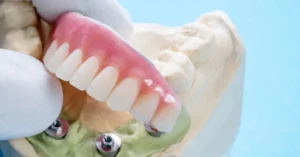ceramic teeth caps