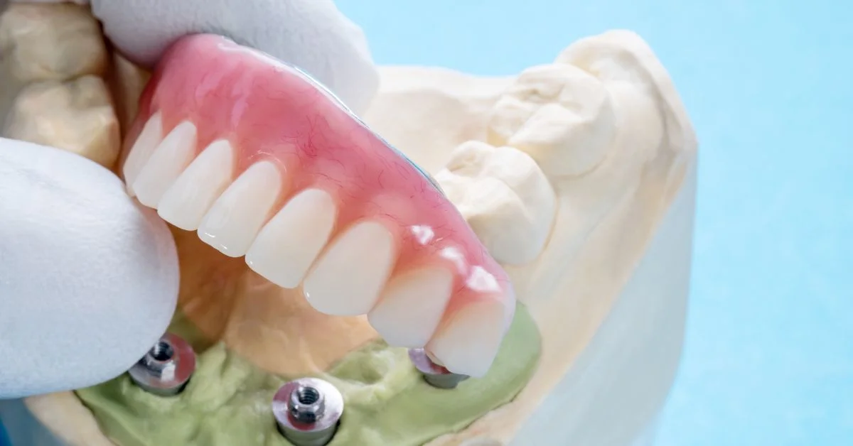 ceramic teeth caps